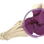 Tibio-talo-calcaneal (TTC) Arthrodesis