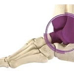 Total Ankle Replacement