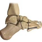 Ortholoc 2 Jones Fracture System