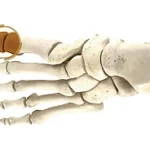 1st Metatarso-phalangeal (MTP) Arthrodesis