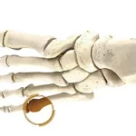 Bunionette (Tailor's Bunion)