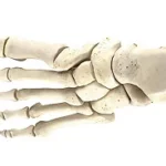 Hallux Interphalangeal Joint (IPJ) Arthrodesis