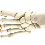 Hammertoe Correction (PIP/DIP Joint)