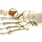 Opening Wedge Osteotomy