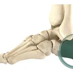 Calcaneal Sliding Osteotomy