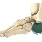 Lateral Column Lengthening (Evans Osteotomy)