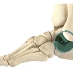 Subtalar Arthroeresis