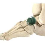 Talonavicular Joint Arthrodesis