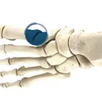 First Tarsometatarsal Joint Arthrodesis