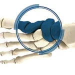 Medial Column Arthrodesis