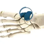 Navicular Cuneiform Arthrodesis